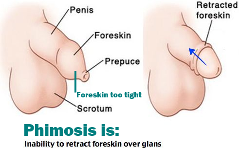 Phimosis