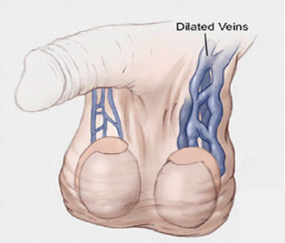 Varicocele